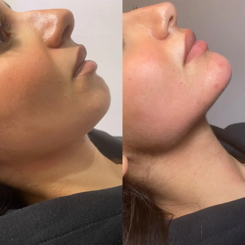 Harmonização Facial