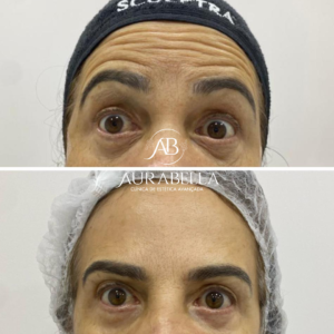 Botox1