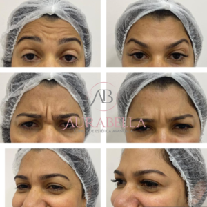 Botox2