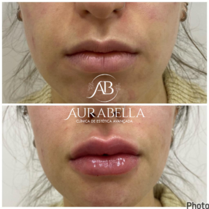 labial