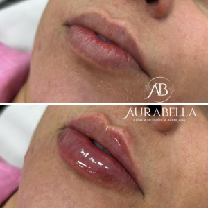 preencimento labial